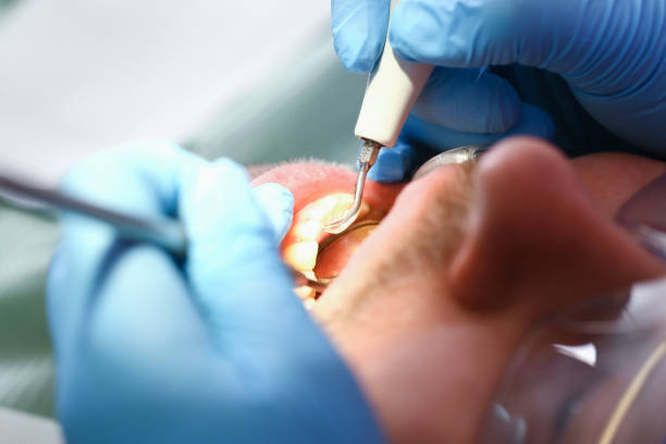 Best Emergency Root Canal Treatment in Middletown, DE